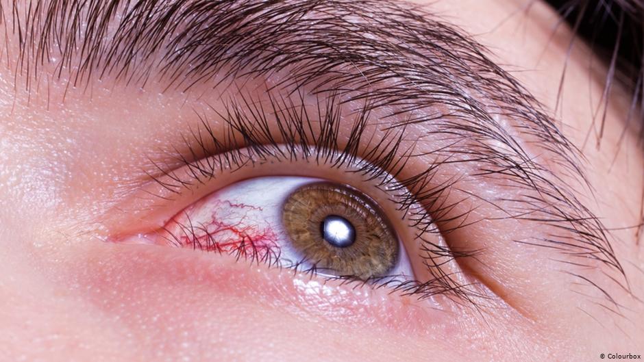 علاج المشاكل الشائعة للعين