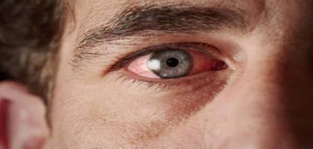 مرض التراخوما – Trachoma
